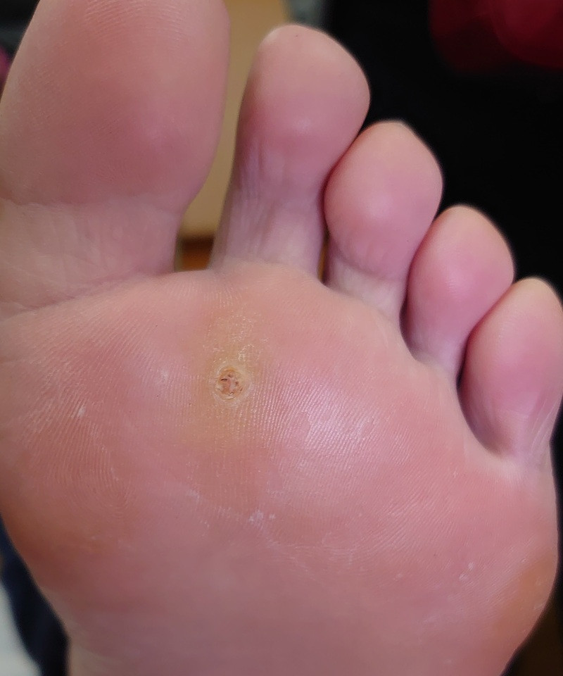 病毒疣治療 腳底長一顆小黑點 