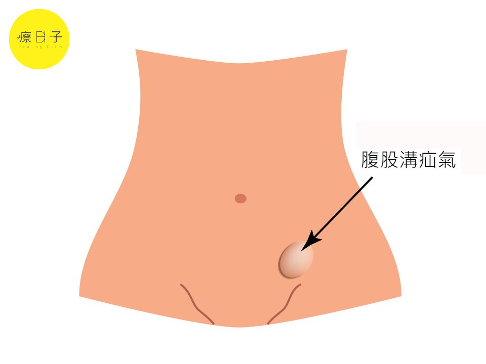 腹股溝疝氣位置圖解
