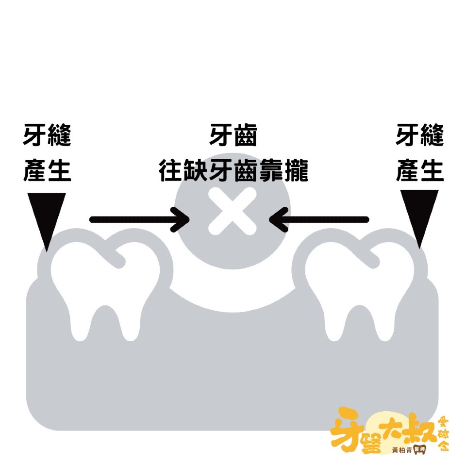 植牙好處 牙齒位移 產生牙縫