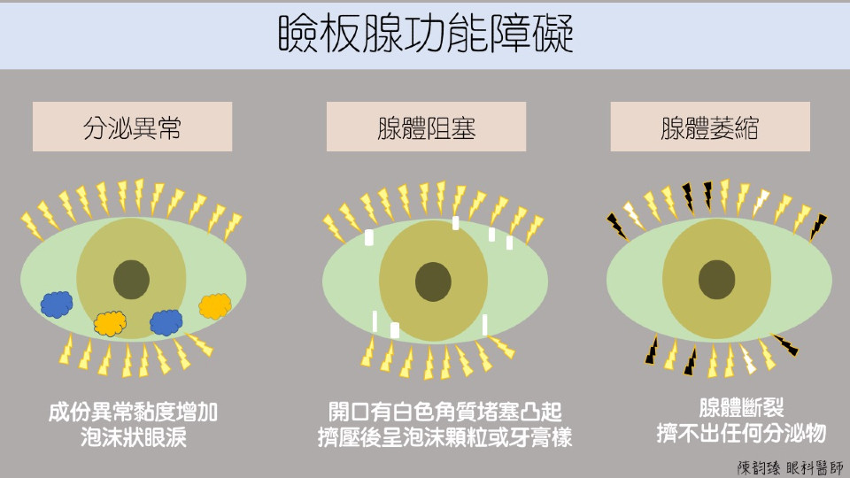 乾眼症症狀 眼瞼板腺功能障礙