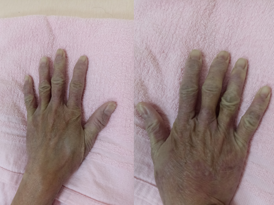 手指退化性關節炎