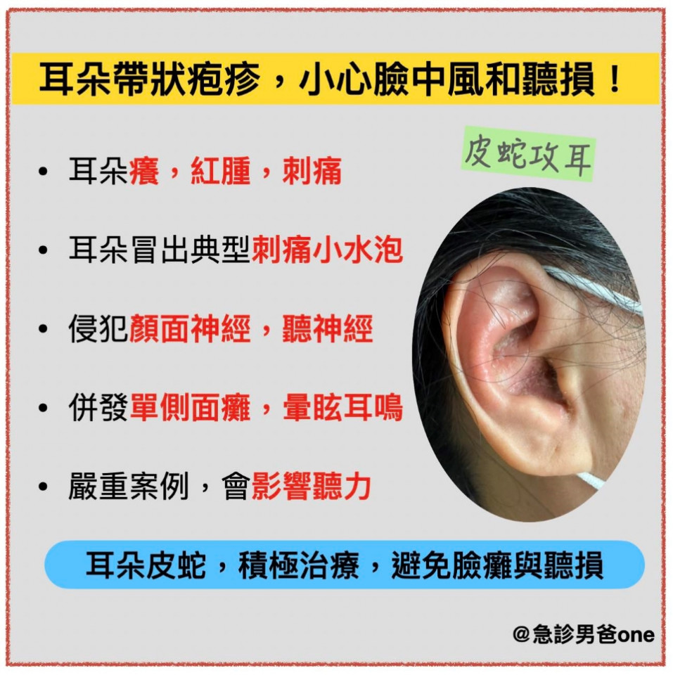 耳朵帶狀皰疹症狀